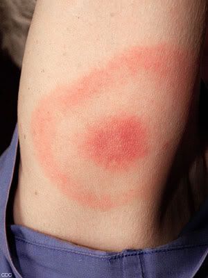 brown recluse spider bite symptoms. Symptoms of Brown Recluse