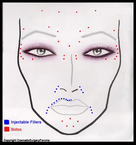 Botox Ptosis Pictures